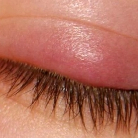 Mắt Sưng Húp Phải Làm Sao? Nguyên Nhân Và Cách Giảm Sưng An Toàn