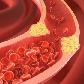 Mỡ Máu Kiêng Ăn Gì? Danh Sách Thực Phẩm Cần Tránh 