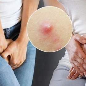 Mọc Mụn Ở Vùng Kín Là Bị Gì? Nguyên Nhân Và Cách Xử Lý