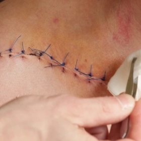 Mới Khâu Vết Thương Nên Ăn Gì Để Mau Lành Và Ít Sẹo?