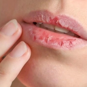 Môi Khô Nứt Nẻ Do Thiếu Chất Gì? Cách Bổ Sung Và Khắc Phục Nhanh