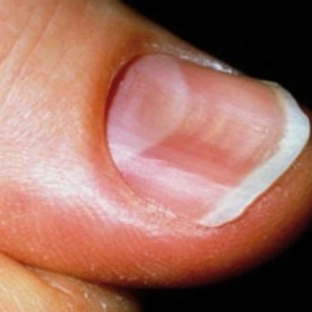 Móng Tay Bị Lõm: Nguyên Nhân, Cách Nhận Biết Và Giải Pháp Phục Hồi