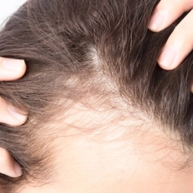 Mounjaro Có Gây Rụng Tóc Không? Nguyên Nhân Và Cách Khắc Phục