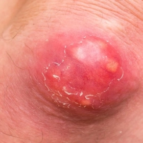 Mụn Áp Xe Có Nguy Hiểm Không? Cách Điều Trị Và Phòng Ngừa Tái Phát