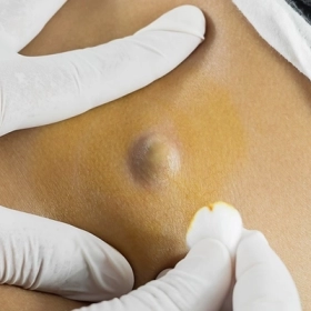 Mụn Bã Đậu Là Gì? Cách Nhận Biết Và Điều Trị Hiệu Quả Tại Nhà