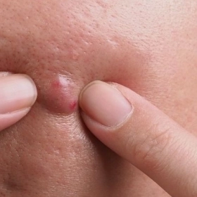Mụn Bị Chai Cứng Dưới Da Phải Làm Sao? Cách Xử Lý Hiệu Quả