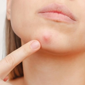 Mụn Bọc Là Gì? Nguyên Nhân, Triệu Chứng Và Cách Điều Trị Hiệu Quả Mụn Bọc Là Gì? Nguyên Nhân, Triệu Chứng Và Cách Điều Trị Hiệu Quả