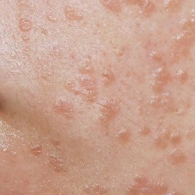 Mụn cóc phẳng: Nguyên nhân, dấu hiệu nhận biết và giải pháp điều trị