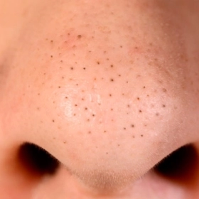 Mụn Đầu Đen Để Lâu Có Sao Không? Tác Hại Và Cách Xử Lý Hiệu Quả