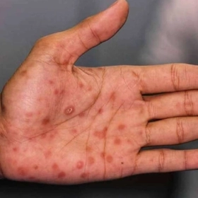 Mụn Do HIV Là Gì? Dấu Hiệu Nhận Biết Và Cách Xử Lý An Toàn