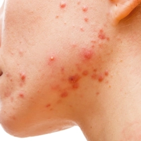 Mụn Mủ Là Gì? Nguyên Nhân, Cách Điều Trị Nhanh Và An Toàn Ngay Tại Nhà