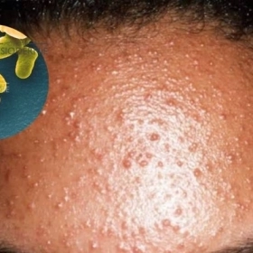 Mụn Nấm Men Là Gì? Nguyên Nhân Và Cách Điều Trị Hiệu Quả