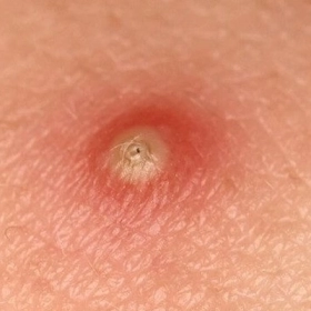 Mụn nhọt Là Gì? Nguyên Nhân, Dấu Hiệu Và Cách Điều Trị An Toàn