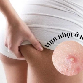 Mụn Nhọt Ở Mông: Nguyên Nhân, Dấu Hiệu Và Cách Điều Trị Hiệu Quả