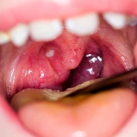 Mụn Nước Trong Miệng Cảnh Báo Bệnh Gì? Nguyên Nhân Và Cách Điều Trị