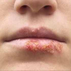 Mụn Rộp Sinh Dục Là Gì? Nguyên Nhân, Triệu Chứng Và Cách Điều Trị Hiệu Quả Mụn Rộp Sinh Dục Là Gì? Nguyên Nhân, Triệu Chứng Và Cách Điều Trị Hiệu Quả