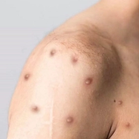 Mụn Thủy Đậu Bao Lâu Thì Khỏi? Cách Chăm Sóc Giúp Mau Lành