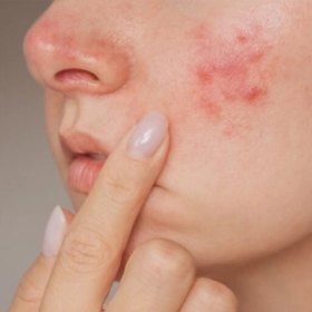 Mụn Trứng Cá Là Gì? Nguyên Nhân, Triệu Chứng Và Cách Điều Trị Hiệu Quả Mụn Trứng Cá Là Gì? Nguyên Nhân, Triệu Chứng Và Cách Điều Trị Hiệu Quả