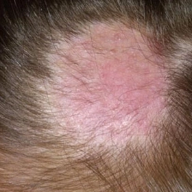 Nấm Da Đầu Là Gì? Nguyên Nhân, Dấu Hiệu Và Cách Điều Trị Hiệu Quả