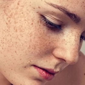 Nám Da Là Gì? Nguyên Nhân, Dấu Hiệu Và Cách Điều Trị Hiệu Quả