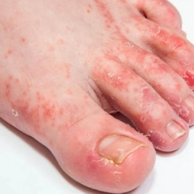 Nấm Kẽ Chân (Nước Ăn Chân): Nhận Biết Sớm Và Điều Trị Đúng Để Tránh Tái Phát