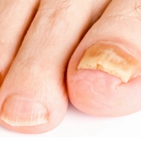 Nấm Móng Chân Là Gì? Nguyên Nhân, Dấu Hiệu Và Cách Điều Trị 