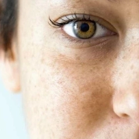 Nám nội tiết: Nguyên nhân, dấu hiệu và phác đồ điều trị dứt điểm