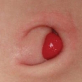 Nang Niệu Rốn Là Gì? Dấu Hiệu Nhận Biết Sớm Và Cách Điều Trị Hiệu Quả