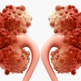 Nang Thận Là Gì? Nguyên Nhân, Triệu Chứng Và Cách Điều Trị Hiệu Quả