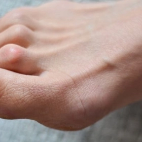 Ngón Chân Hình Búa: Nguyên Nhân, Triệu Chứng Và Cách Điều Trị