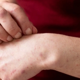 Ngứa Da Do Tiểu Đường: Nguyên Nhân, Dấu Hiệu Và Cách Điều Trị