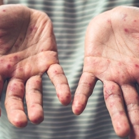 Người Lớn Có Bị Tay Chân Miệng Không? Sự Thật Bạn Cần Biết