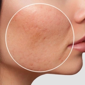 Nguyên Nhân Khiến Sẹo Đáy Nhọn Khó Điều Trị Hơn Sẹo Lõm Khác