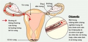 Nhiễm khuẩn Chlamydia Nhiễm khuẩn Chlamydia