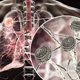 Nhiễm Nấm Coccidioidomycosis Là Gì? Dấu Hiệu Và Cách Điều Trị