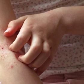 Nhiễm Sán Máng Là Gì? Nguyên Nhân, Triệu Chứng Và Cách Điều Trị