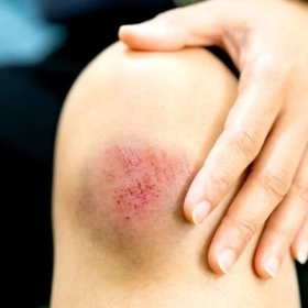 Dấu Hiệu Nhiễm Trùng Vết Thương Cần Đi Bệnh Viện Ngay