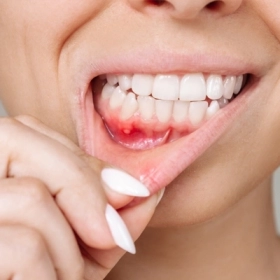 Nhiệt Miệng Uống Gì Nhanh Khỏi? Top 10 Thức Uống Giúp Giải Nhiệt Hiệu Quả