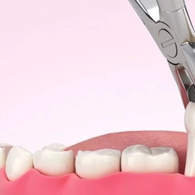 Nhổ Răng Khôn Kiêng Ăn Gì? 10+ Thực Phẩm Cần Tránh