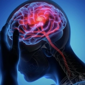 Nhồi máu não: Dấu hiệu, nguyên nhân và cách cấp cứu