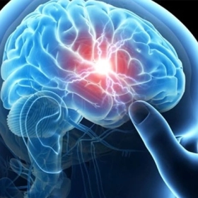 Nhũn não: Nguyên nhân, dấu hiệu và hướng xử trí