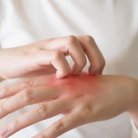 Nổi mẩn ngứa: Nguyên nhân, dấu hiệu và cách điều trị hiệu quả