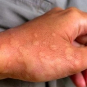 Nổi Mề Đay Là Gì? Dấu Hiệu Nhận Biết Và Cách Chữa Trị An Toàn