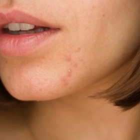 Nổi Mụn Dưới Cằm Do Đâu? Cách Xử Lý Và Ngăn Ngừa Tái Phát Hiệu Quả