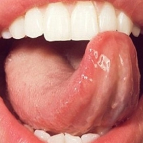 Nổi Mụn Ở Lưỡi: Dấu Hiệu Cảnh Báo Bệnh Lý Bạn Không Nên Bỏ Qua