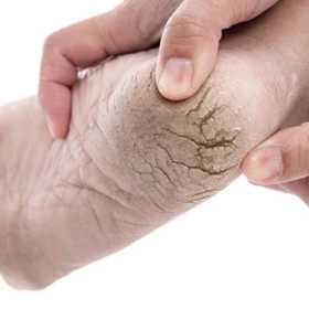 Nứt gót chân là gì? Nguyên nhân, dấu hiệu và cách điều trị