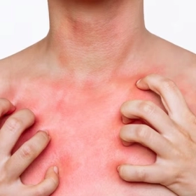 Phát Ban Ở Ngực Là Gì? Nguyên Nhân, Triệu Chứng Và Cách Điều Trị