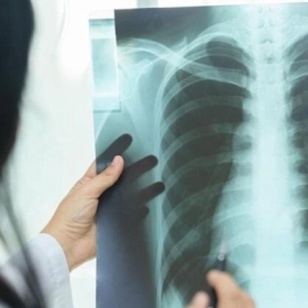 Phát Hiện Vôi Hóa Phổi Khi Khám Sức Khỏe: Có Đáng Lo Không?