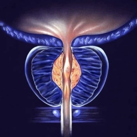 Phì đại tuyến tiền liệt: Nguyên nhân, triệu chứng và giải pháp điều trị