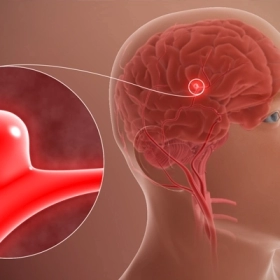 Phình Mạch Máu Não Là Gì? Nguyên Nhân, Dấu Hiệu Và Cách Phát Hiện Sớm